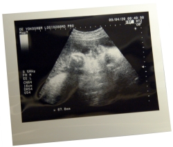 娘の超音波検査の写真