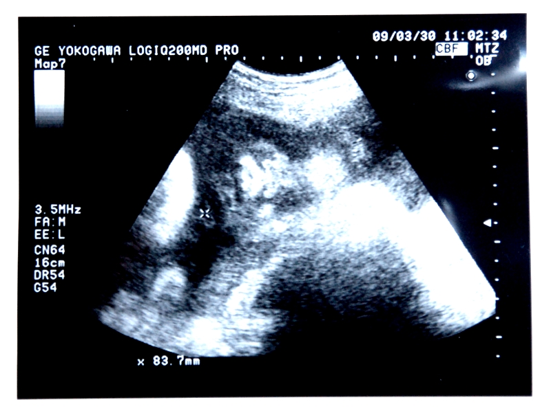 妊娠10か月の退治の超音波画像