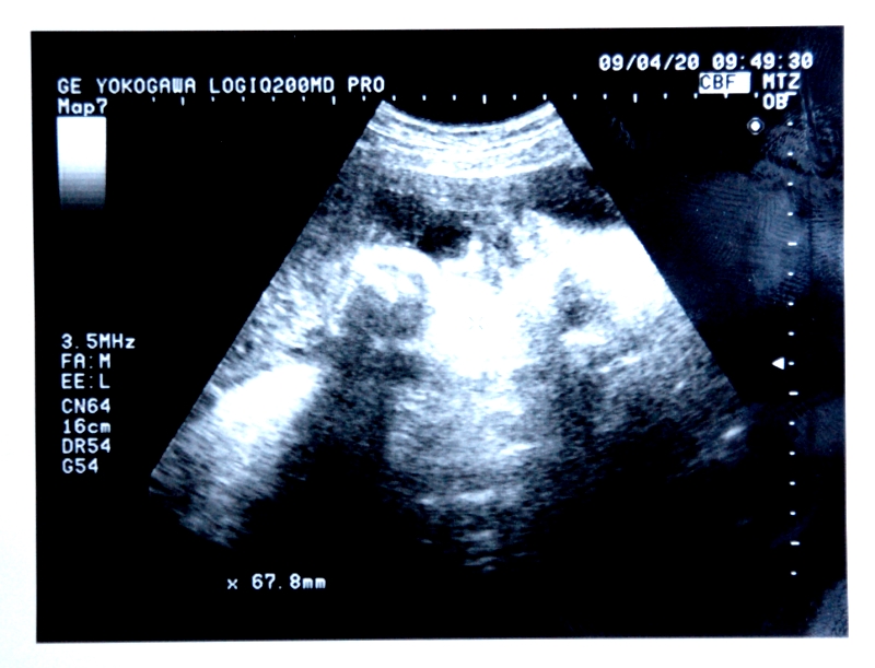 臨月の退治の超音波画像