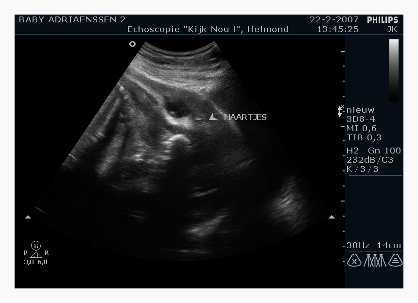 ２か月の超音波写真