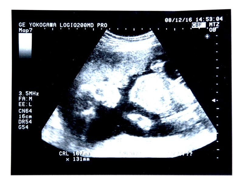 妊娠７か月の退治の超音波画像
