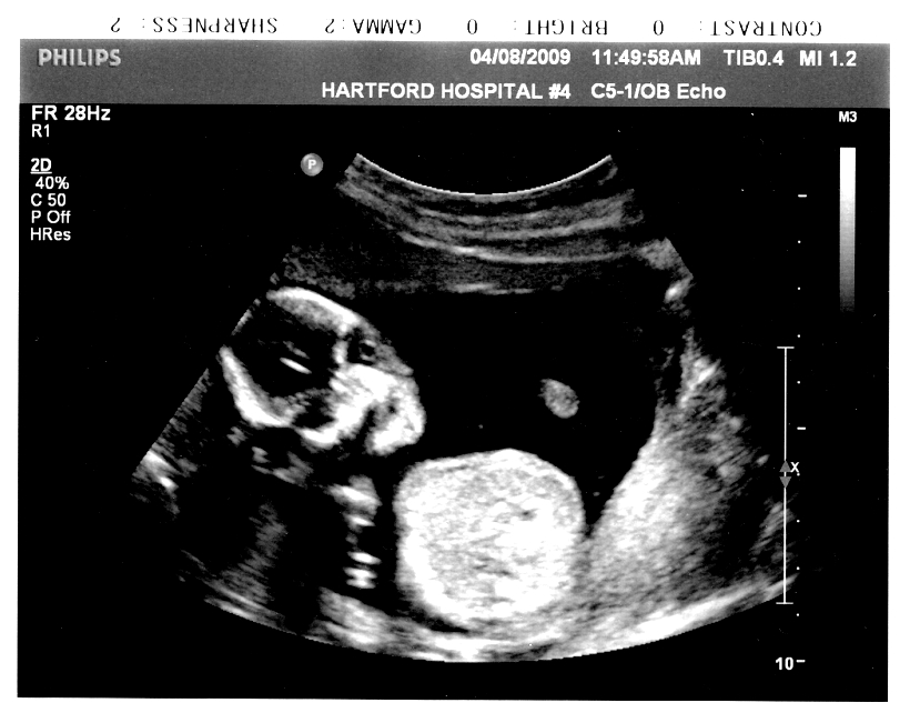 妊娠８か月の退治の超音波画像