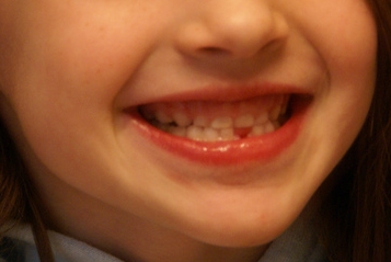 娘の歯のイメージ